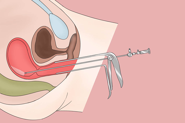 宫腔镜手术是什么手术