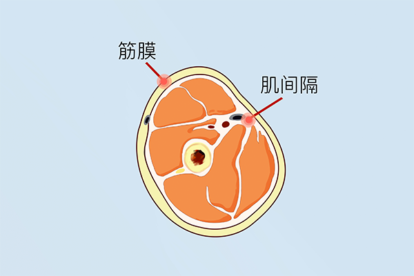 筋膜炎中医治疗知多少