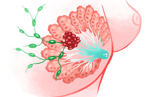 乳腺结节中医治疗最好的方法