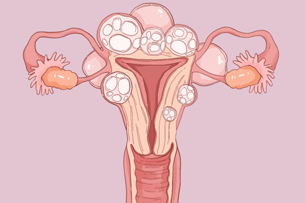 子宫肌瘤有哪些症状